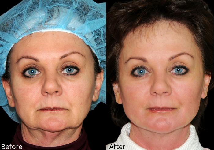 Before & After Y Lift Instant Facelift Case 343 View 1 View in Santa Rosa, California
