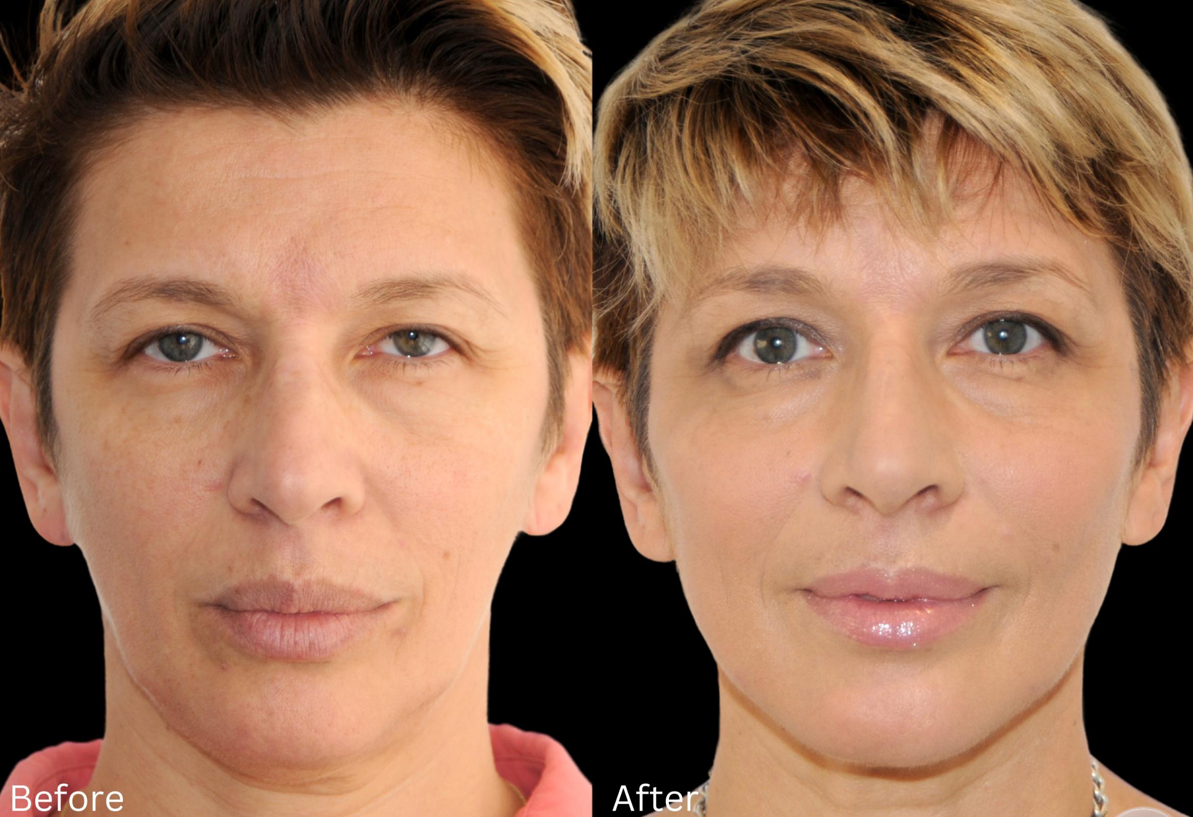 Before & After Y Lift Instant Facelift Case 344 View 1 View in Santa Rosa, California