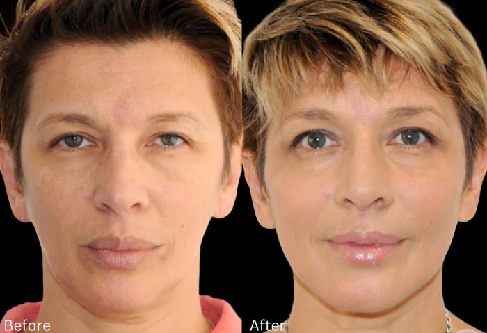 Before & After Y Lift Instant Facelift Case 344 View 1 View in Santa Rosa, California