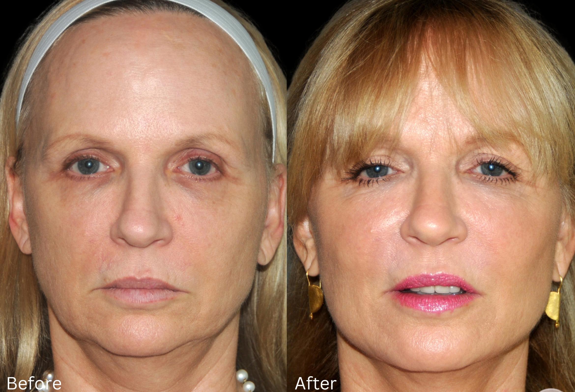 Before & After Y Lift Instant Facelift Case 345 View 1 View in Santa Rosa, California