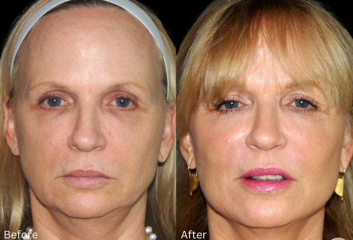 Before & After Y Lift Instant Facelift Case 345 View 1 View in Santa Rosa, California