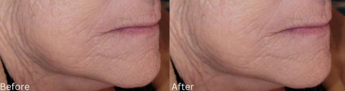Before & After Y Lift Instant Facelift Case 346 View 1 View in Santa Rosa, California