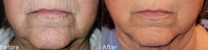 Before & After JET Plasma Case 347 View 1 View in Santa Rosa, California