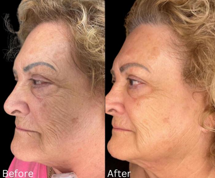 Before & After JET Plasma Case 348 View 1 View in Santa Rosa, California
