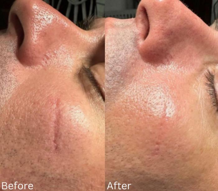Before & After Y Lift Instant Facelift Case 350 View 1 View in Santa Rosa, California