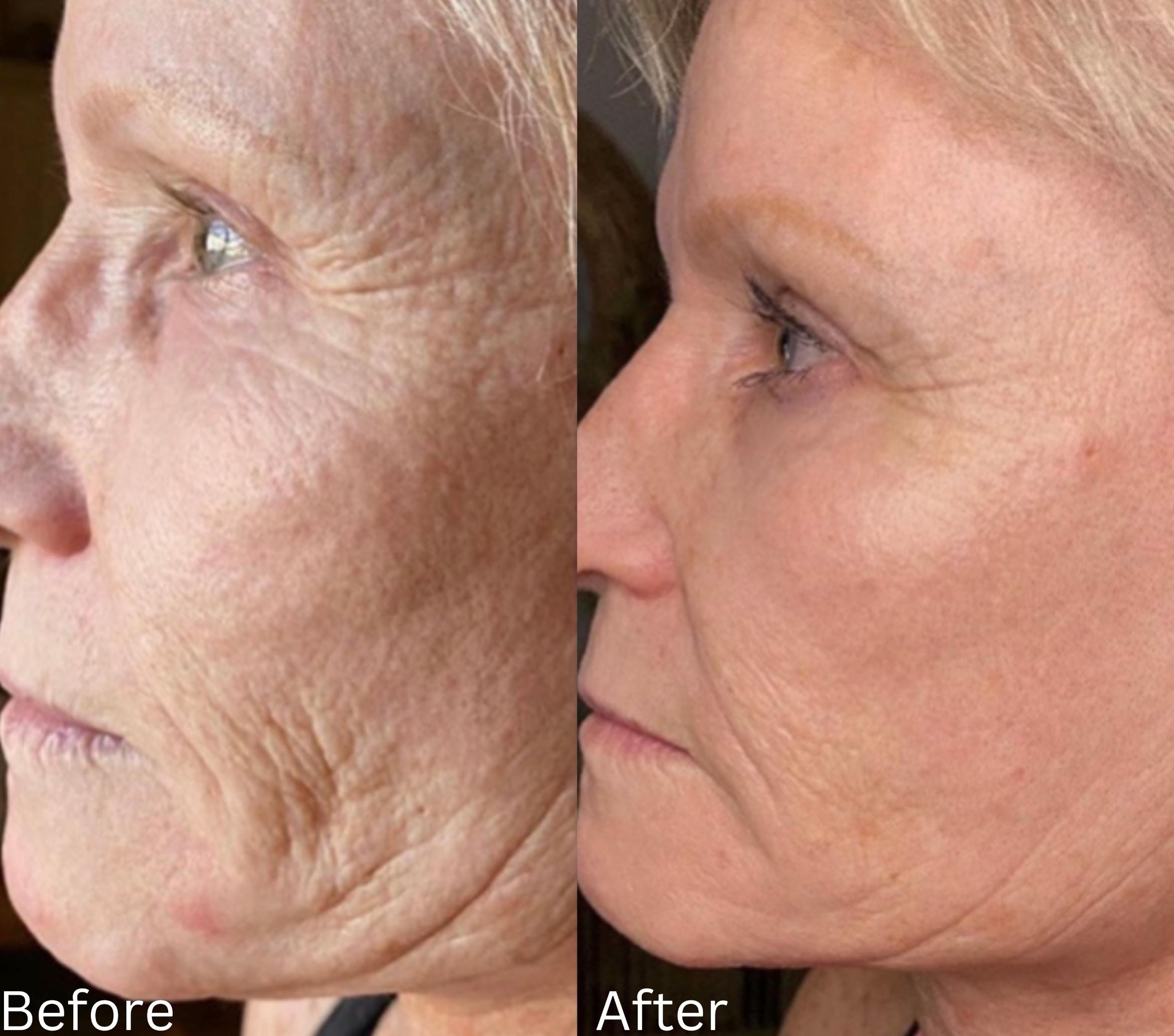 Before & After JET Plasma Case 351 View 1 View in Santa Rosa, California