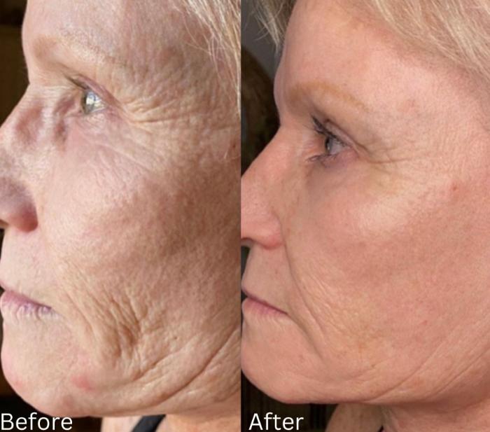 Before & After JET Plasma Case 351 View 1 View in Santa Rosa, California