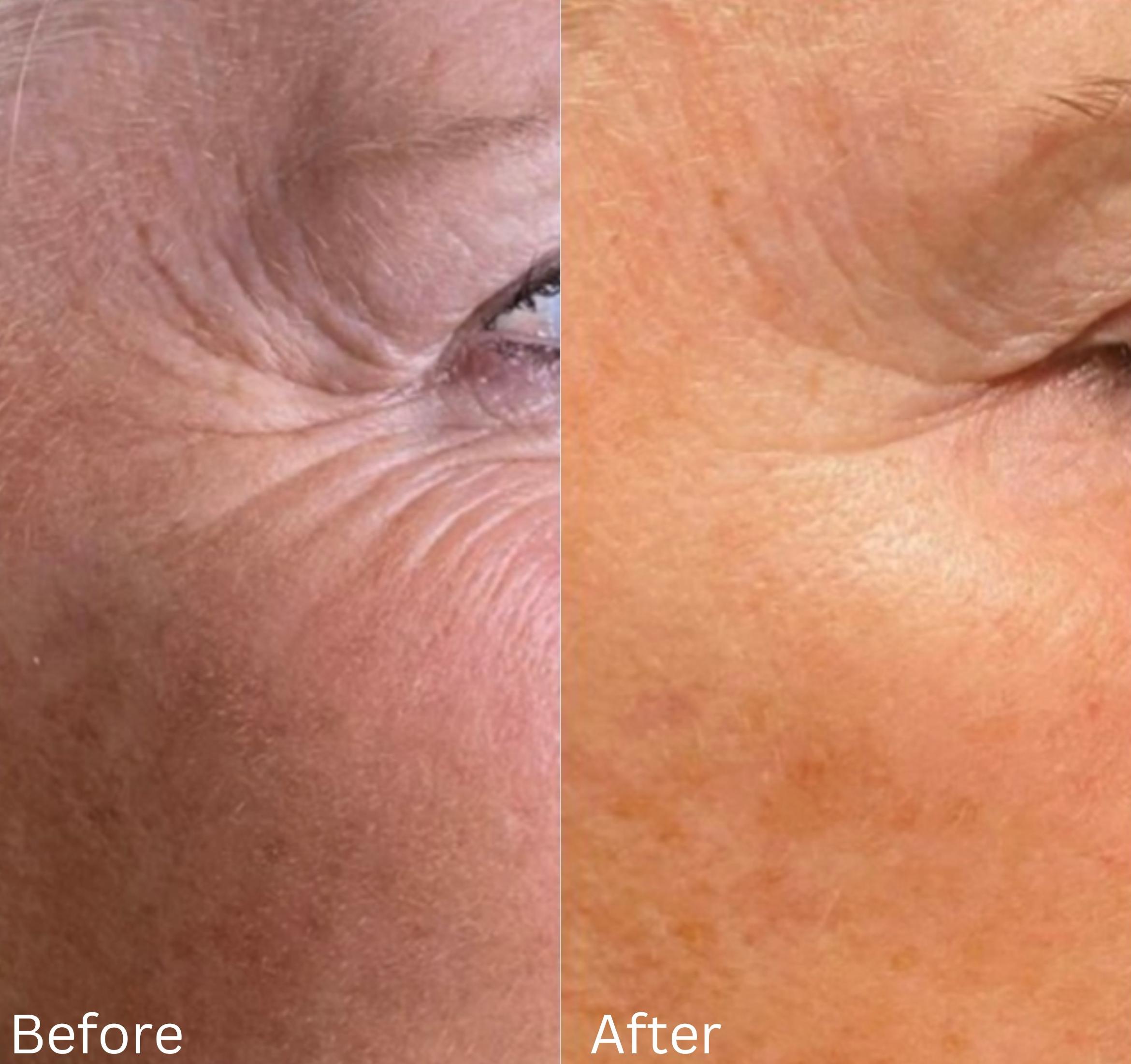 Before & After Y Lift Instant Facelift Case 352 View 1 View in Santa Rosa, California