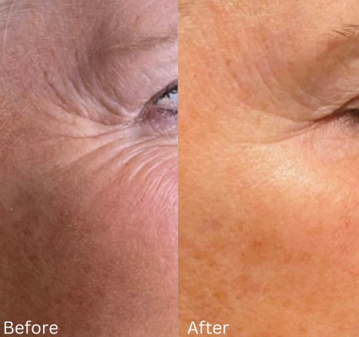 Before & After Y Lift Instant Facelift Case 352 View 1 View in Santa Rosa, California