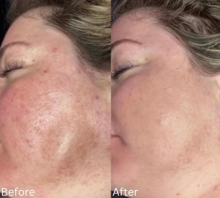 Before & After JET Plasma Case 353 View 1 View in Santa Rosa, California