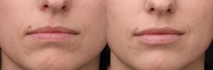 Before & After Y Lift Instant Facelift Case 385 View 1 View in Santa Rosa, California