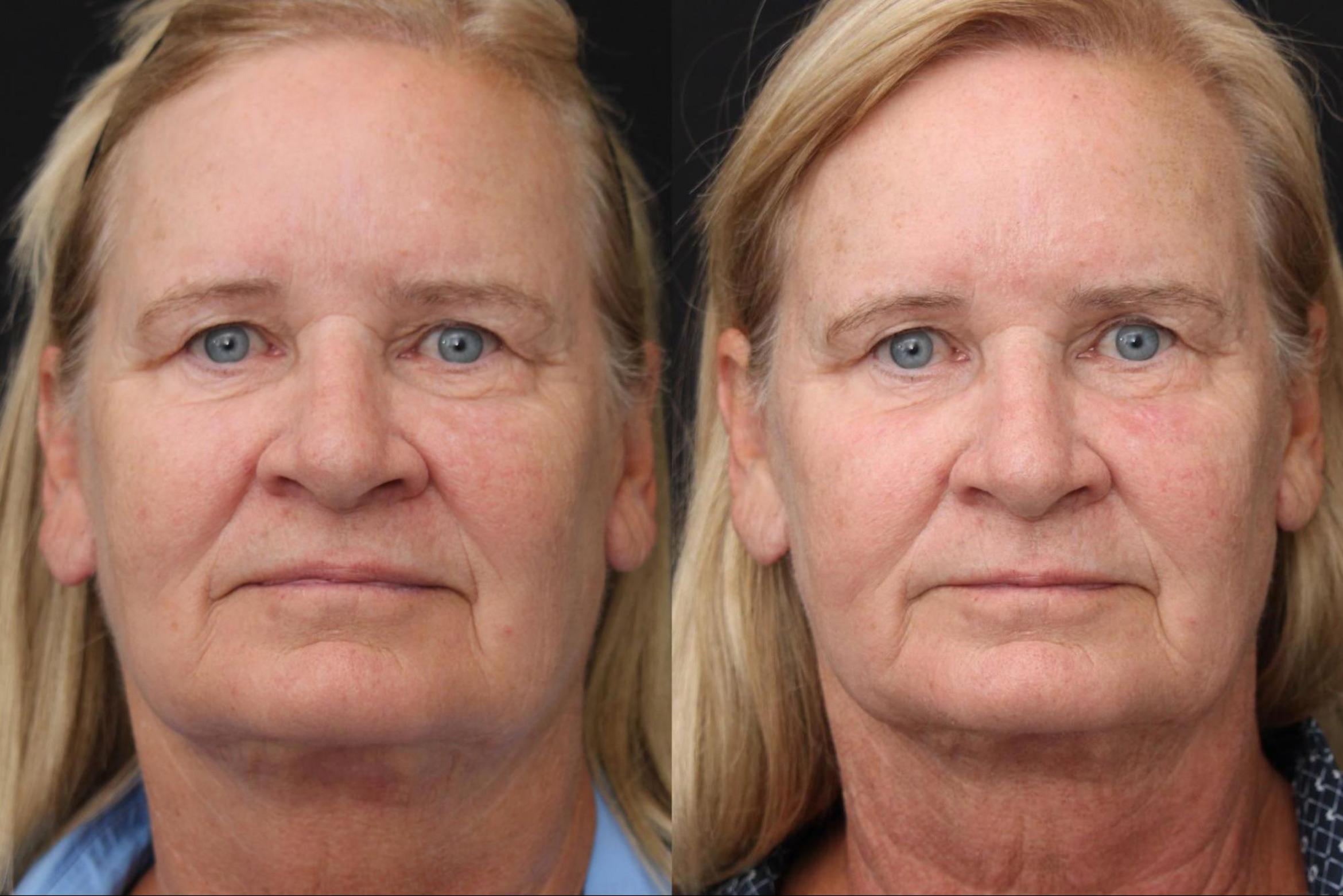 Before & After Y Lift Instant Facelift Case 389 View 1 View in Santa Rosa, California
