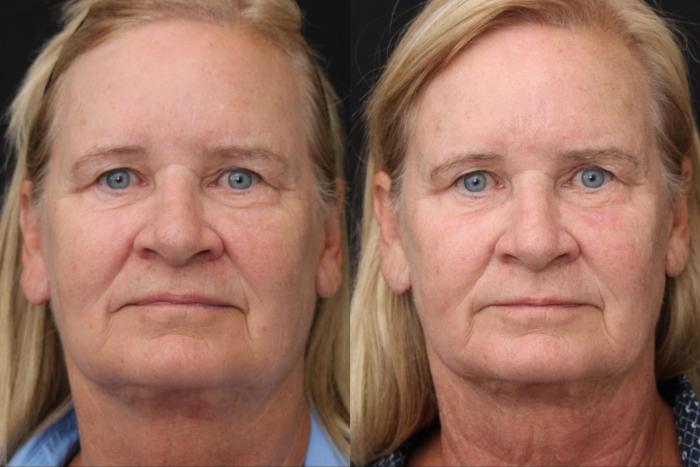Before & After Y Lift Instant Facelift Case 389 View 1 View in Santa Rosa, California