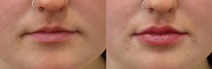 Before & After Y Lift Instant Facelift Case 397 View 1 View in Santa Rosa, California