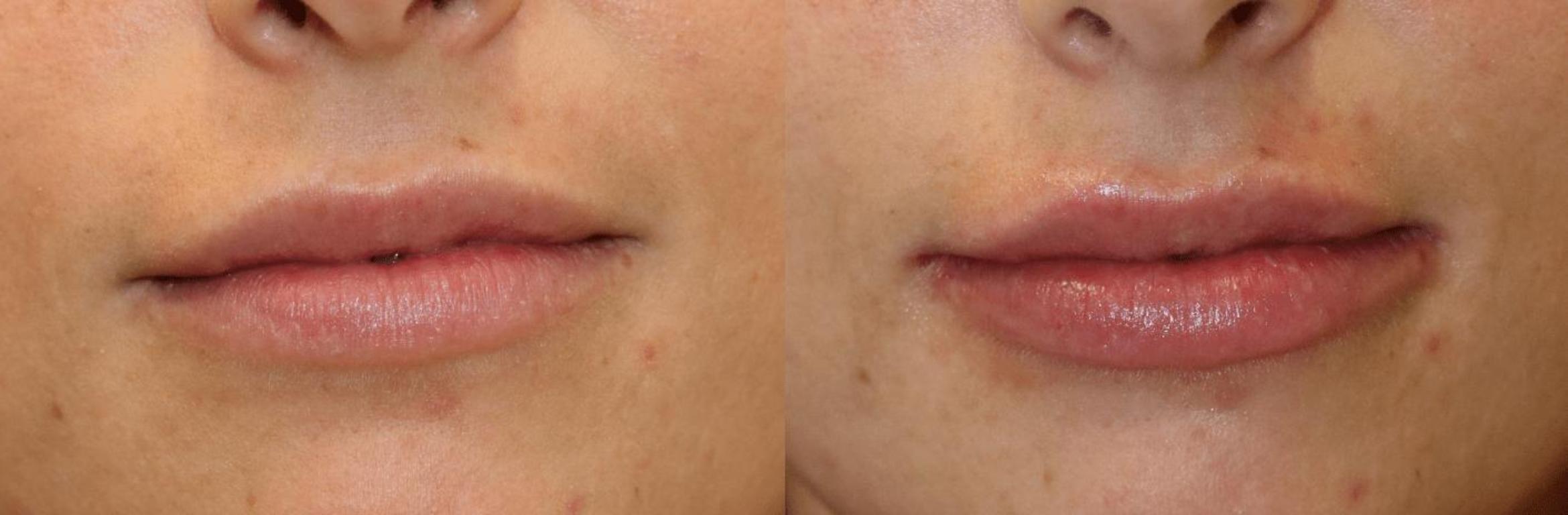 Before & After Y Lift Instant Facelift Case 398 View 1 View in Santa Rosa, California
