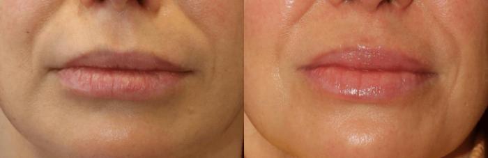 Before & After Y Lift Instant Facelift Case 399 View 1 View in Santa Rosa, California