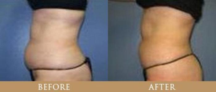 Before & After Y Lift Instant Facelift Case 5 View 1 View in Santa Rosa, California