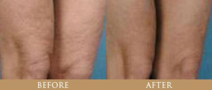 Before & After Y Lift Instant Facelift Case 6 View 1 View in Santa Rosa, California