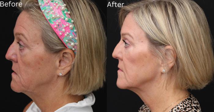 Before & After Y Lift Instant Facelift Case 63 View 2 View in Santa Rosa, California