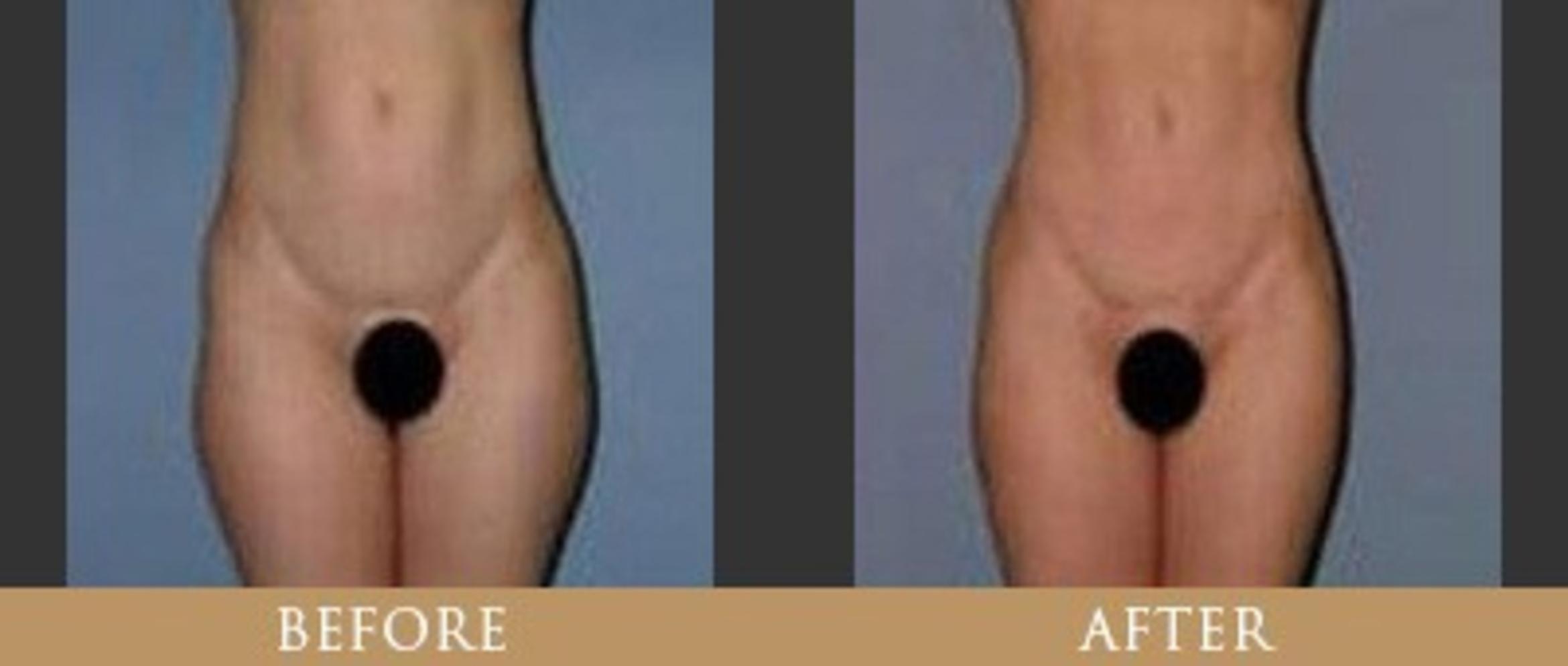Before & After Y Lift Instant Facelift Case 7 View 1 View in Santa Rosa, California
