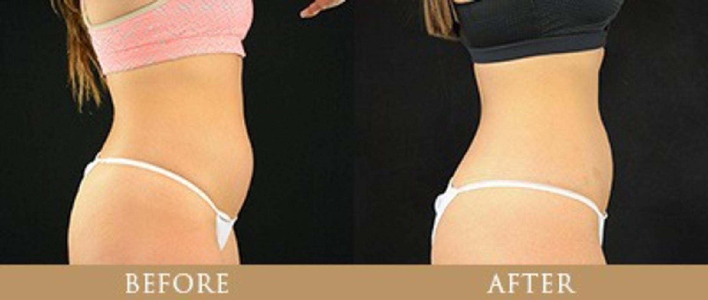 Before & After Y Lift Instant Facelift Case 73 View 1 View in Santa Rosa, California