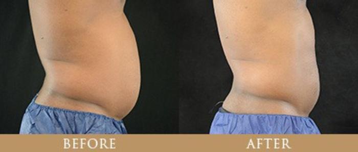 Before & After Y Lift Instant Facelift Case 74 View 1 View in Santa Rosa, California