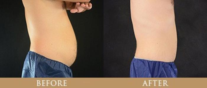 Before & After Y Lift Instant Facelift Case 75 View 1 View in Santa Rosa, California