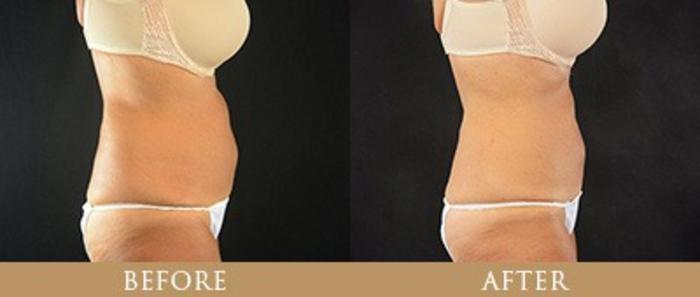 Before & After Y Lift Instant Facelift Case 76 View 1 View in Santa Rosa, California