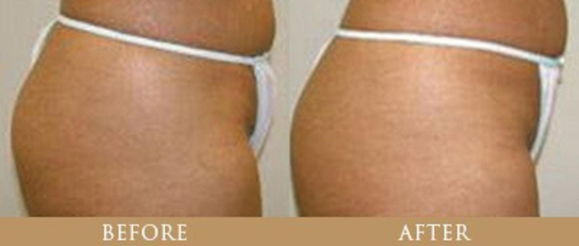 Before & After Y Lift Instant Facelift Case 84 View 1 View in Santa Rosa, California