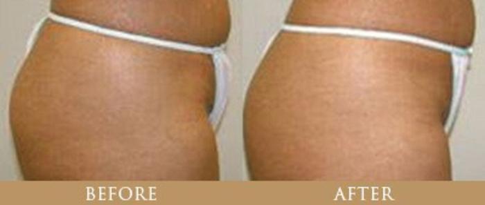 Before & After Y Lift Instant Facelift Case 84 View 1 View in Santa Rosa, California