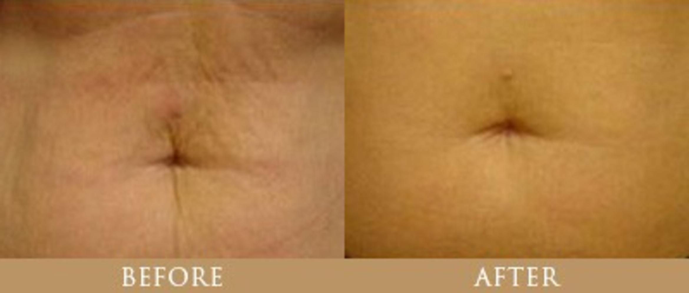 Before & After Y Lift Instant Facelift Case 85 View 1 View in Santa Rosa, California