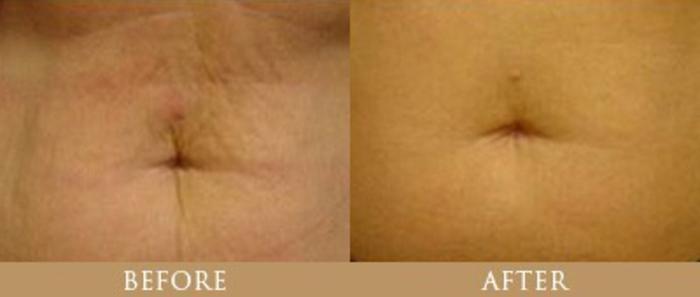 Before & After Y Lift Instant Facelift Case 85 View 1 View in Santa Rosa, California