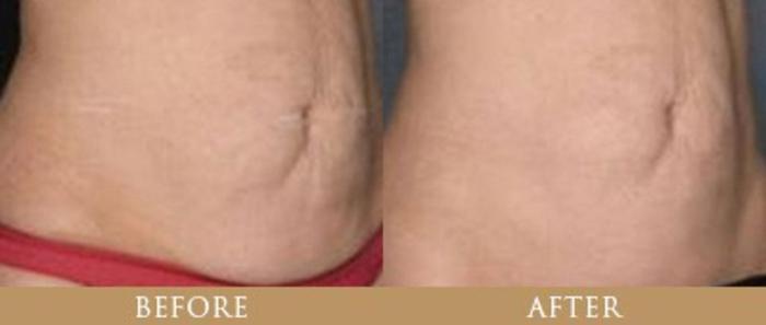 Before & After Y Lift Instant Facelift Case 86 View 1 View in Santa Rosa, California