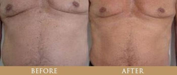 Before & After Y Lift Instant Facelift Case 87 View 1 View in Santa Rosa, California
