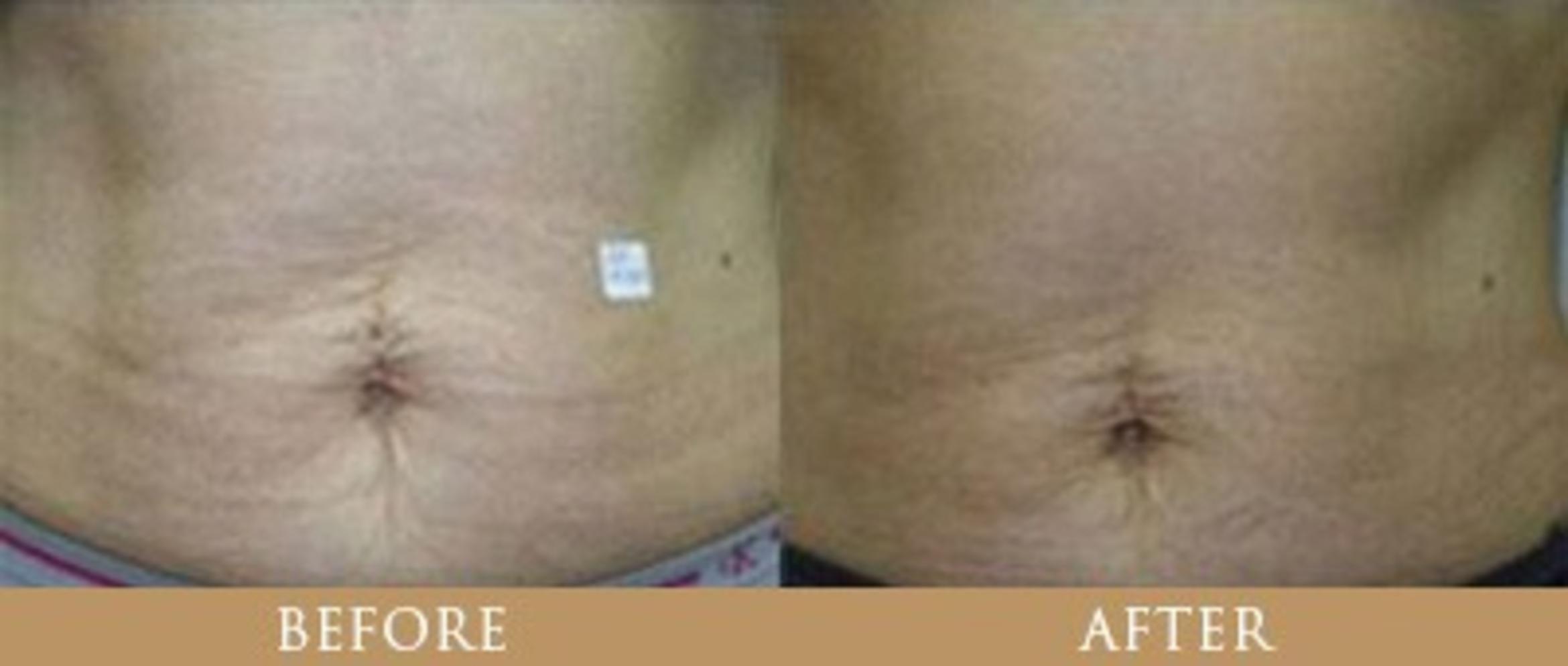 Before & After Y Lift Instant Facelift Case 88 View 1 View in Santa Rosa, California