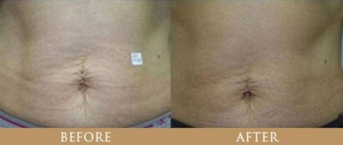 Before & After Y Lift Instant Facelift Case 88 View 1 View in Santa Rosa, California