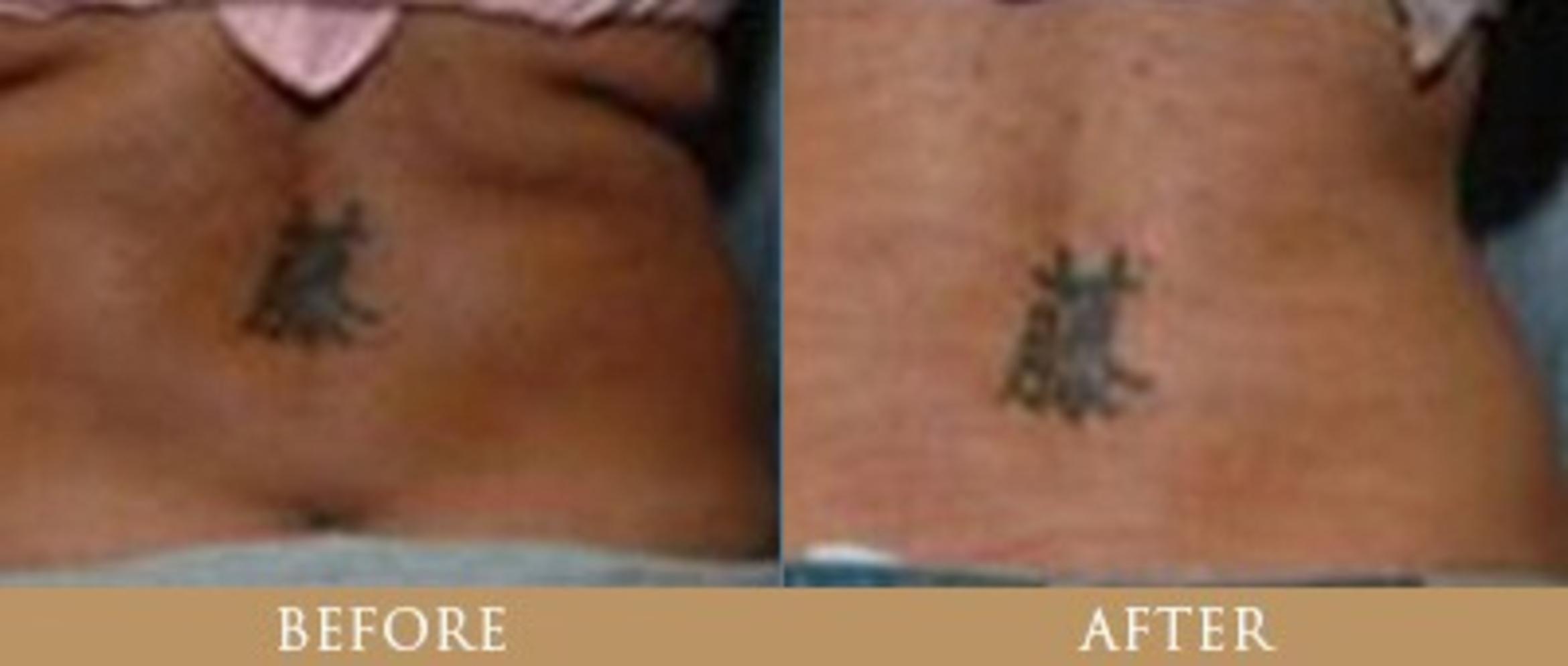 Before & After Y Lift Instant Facelift Case 89 View 1 View in Santa Rosa, California