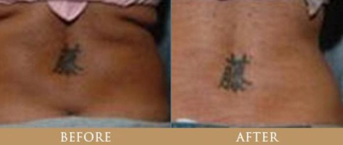 Before & After Y Lift Instant Facelift Case 89 View 1 View in Santa Rosa, California