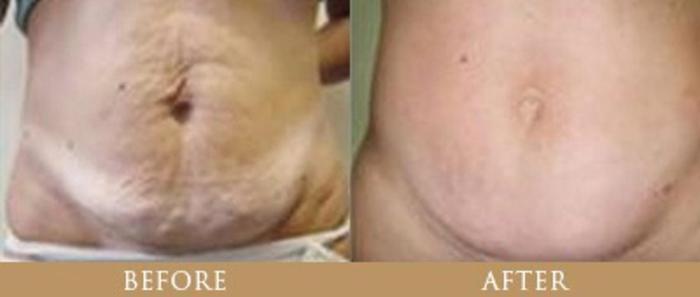 Before & After Y Lift Instant Facelift Case 91 View 1 View in Santa Rosa, California