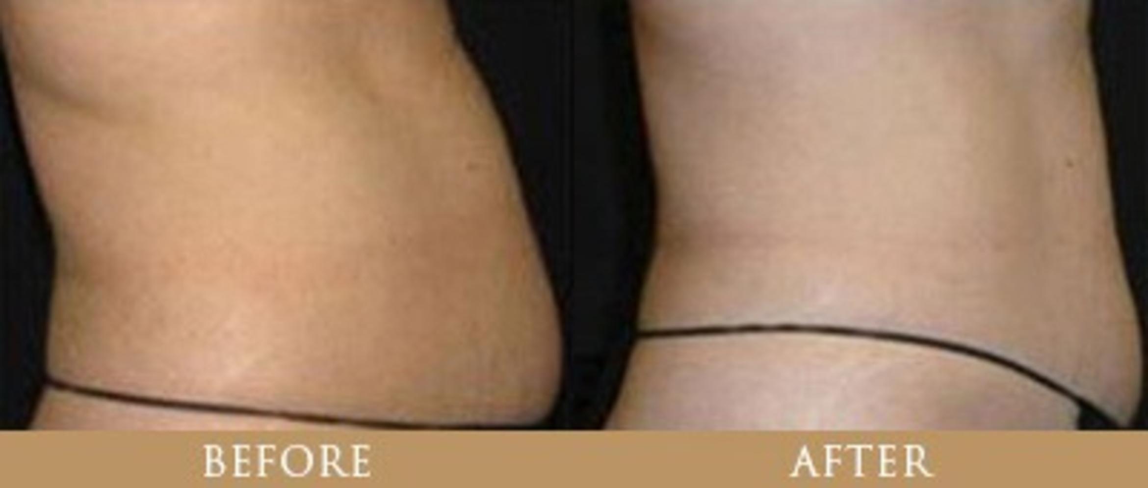 Before & After Y Lift Instant Facelift Case 92 View 1 View in Santa Rosa, California