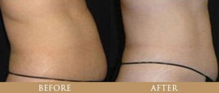 Before & After Y Lift Instant Facelift Case 92 View 1 View in Santa Rosa, California