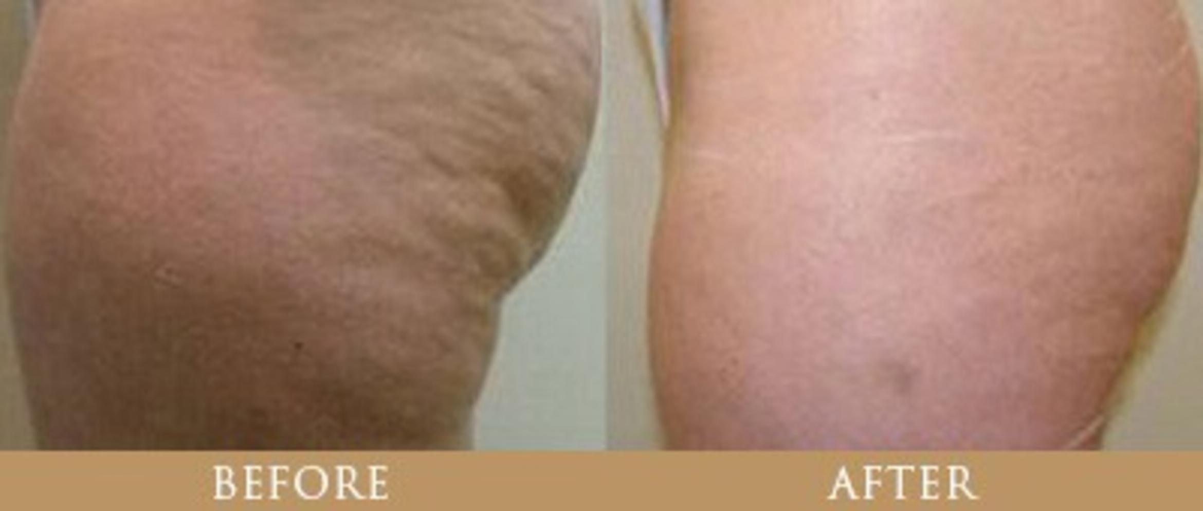 Before & After Y Lift Instant Facelift Case 93 View 1 View in Santa Rosa, California