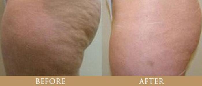 Before & After Y Lift Instant Facelift Case 93 View 1 View in Santa Rosa, California