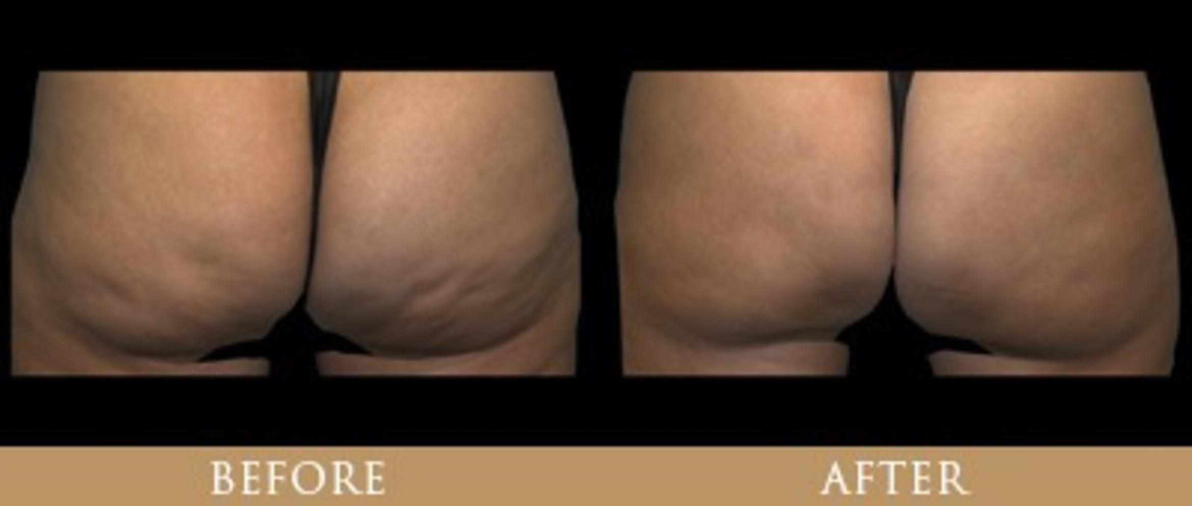 Before & After Y Lift Instant Facelift Case 94 View 1 View in Santa Rosa, California