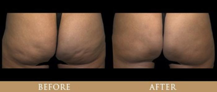 Before & After Y Lift Instant Facelift Case 94 View 1 View in Santa Rosa, California